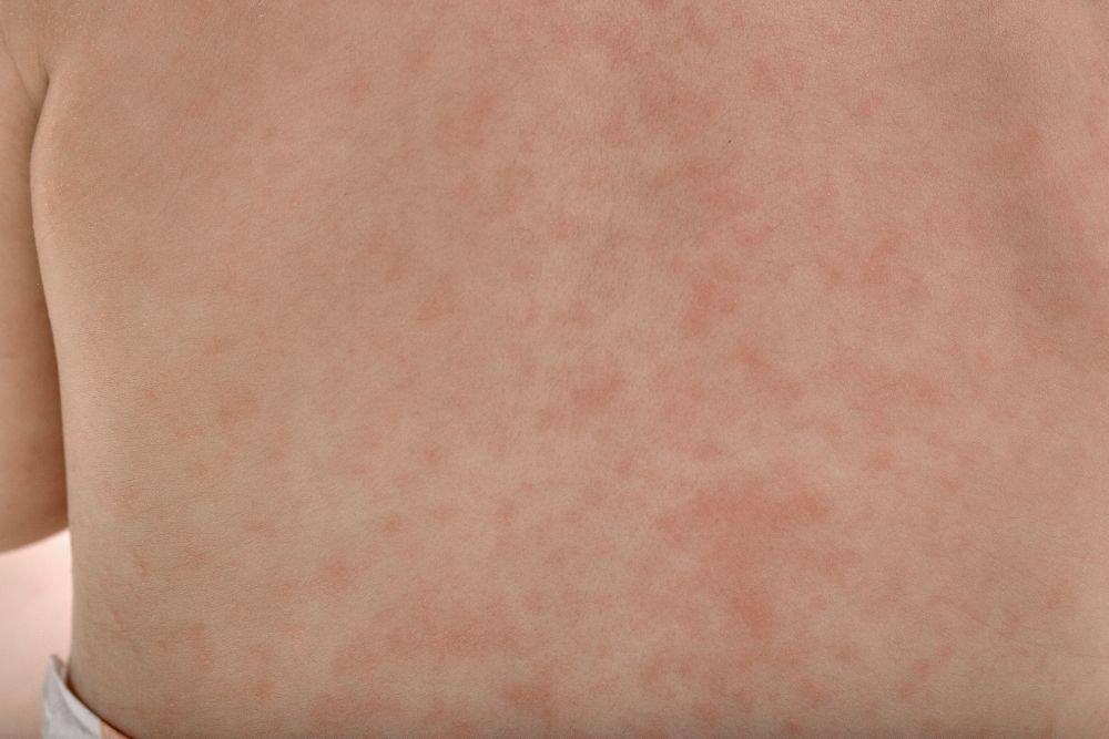 bebé com pintinhas vermelhas após febre